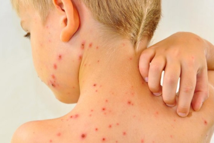 Csúcsot dönt a bárányhimlős megbetegedések száma